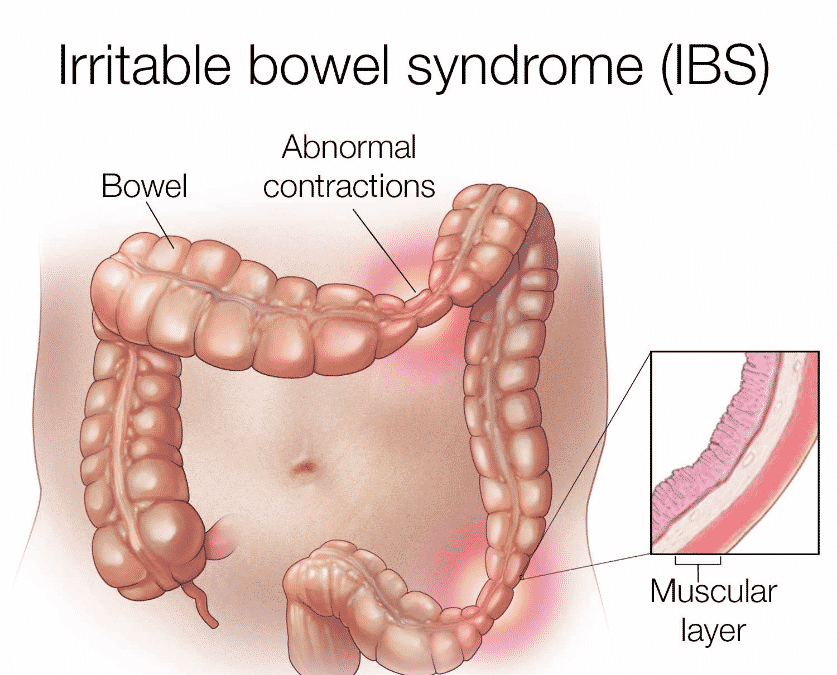 Diet-for-IBS-Irritable-Bowel-syndrome-837x675